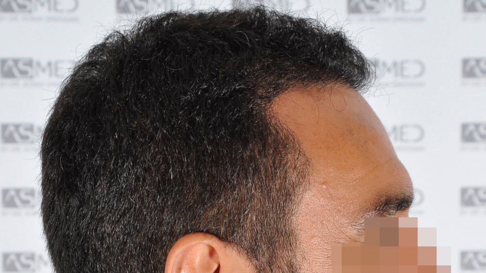 Norwood3 3500-grafts-FUE 10