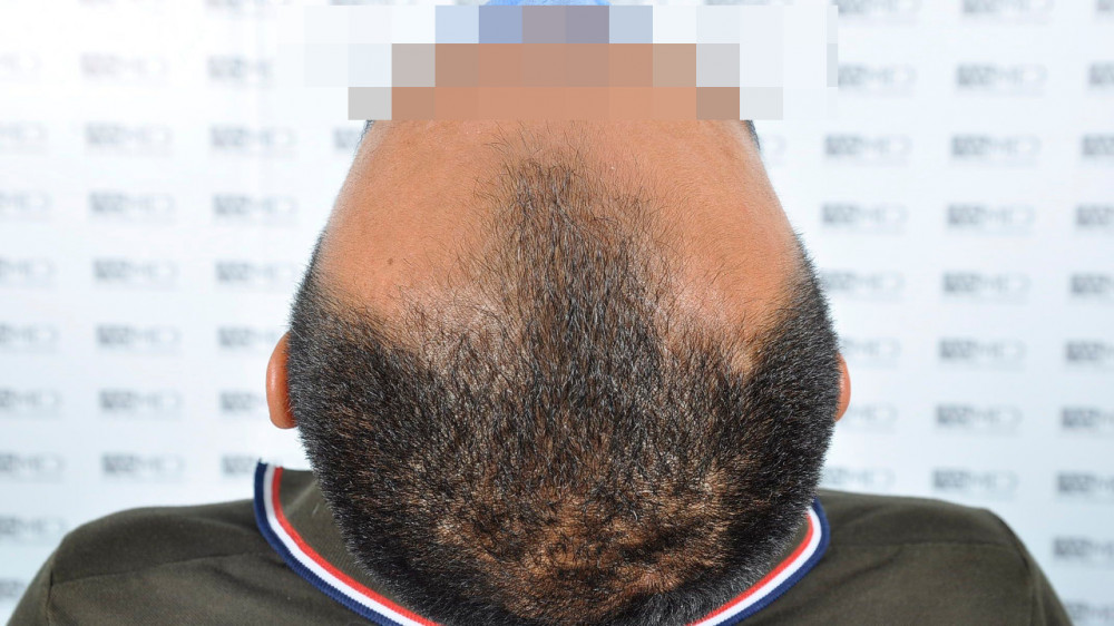 Norwood3 3500-grafts-FUE 11