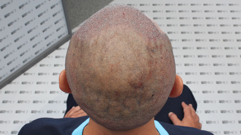 Norwood3 3500-grafts-FUE 15