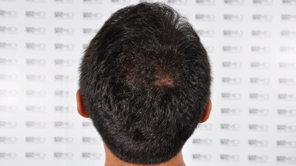 Norwood3 3500-grafts-FUE 16
