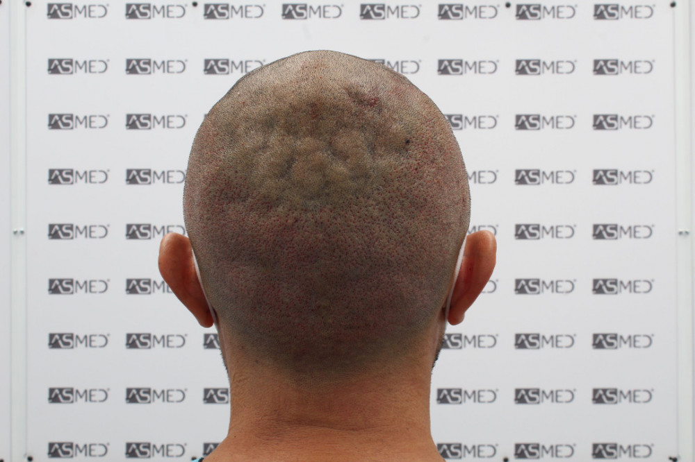 Norwood3 3500-grafts-FUE 18