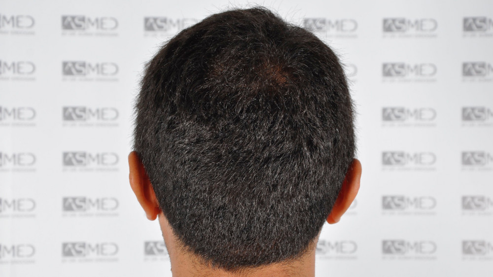 Norwood3 3500-grafts-FUE 19