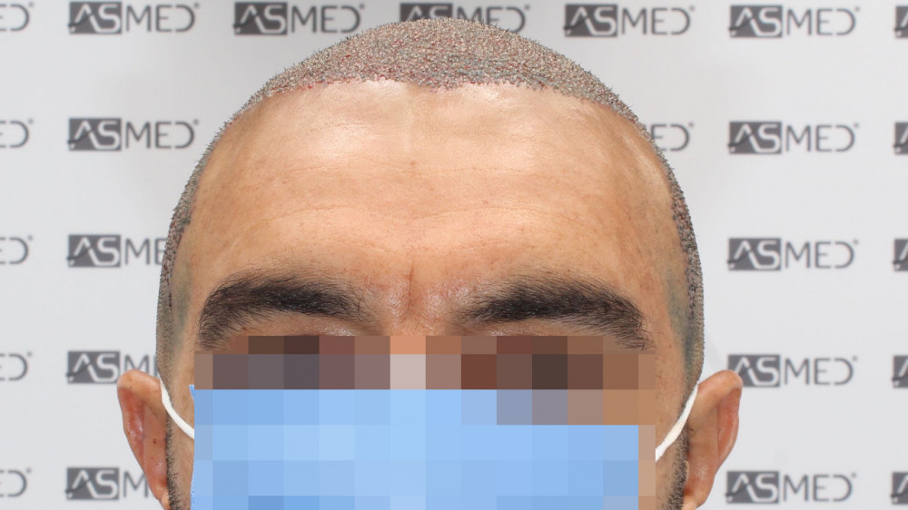 Norwood3 3500-grafts-FUE 3