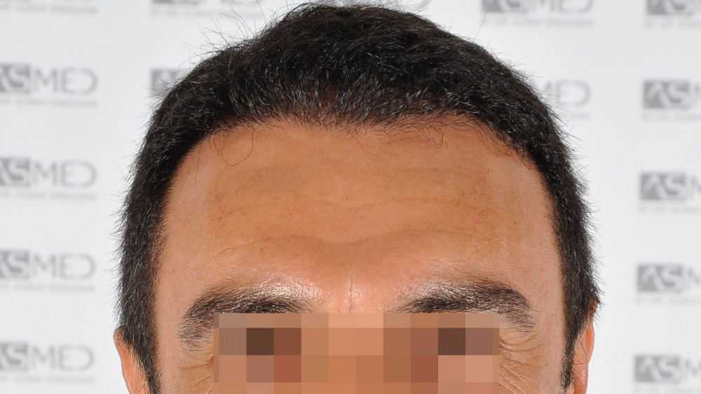 Norwood3 3500-grafts-FUE 4