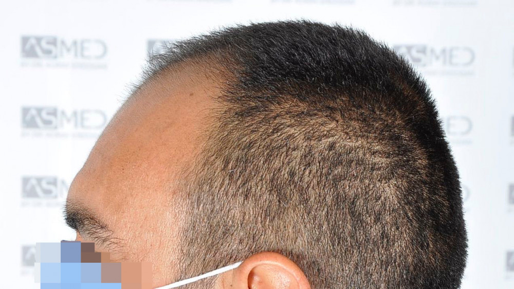 Norwood3 3500-grafts-FUE 5