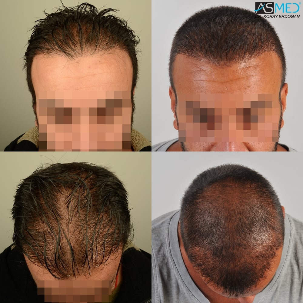 4000-grafts-FUE