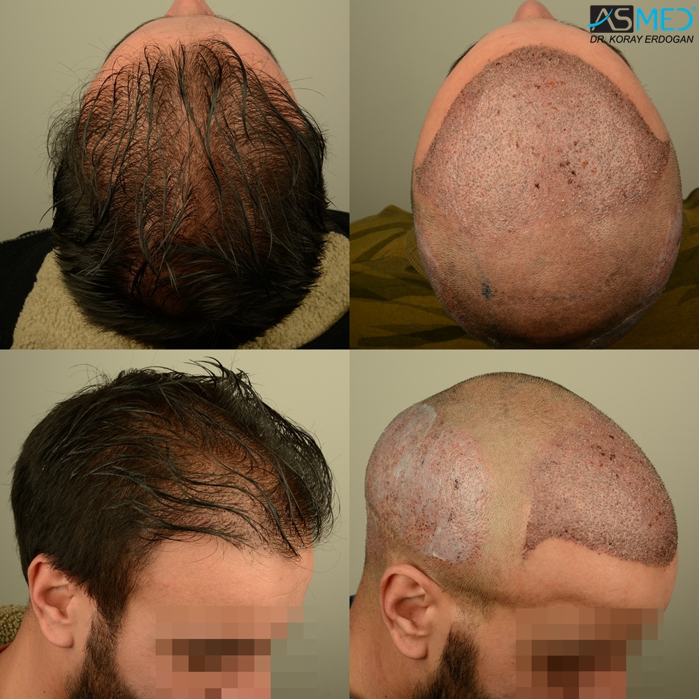 Norwood3 4000-grafts-FUE result2_zps790725a8