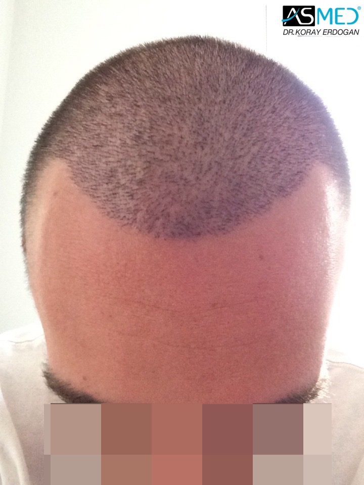 Norwood3 4006-grafts-FUE V2_3d225a282041fe592c77cba9d1e99c38_zps90681b73