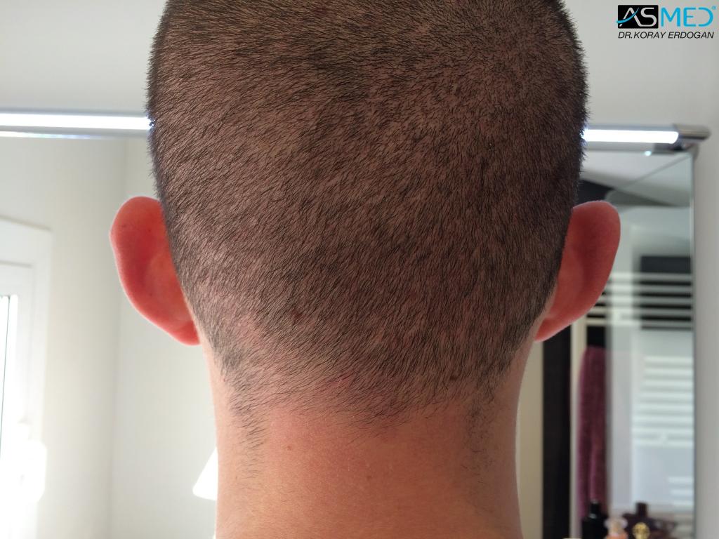 Norwood3 4006-grafts-FUE V2_516c0b2540e3ce852d0ae41edbbf5b55_zpsb997f9b4