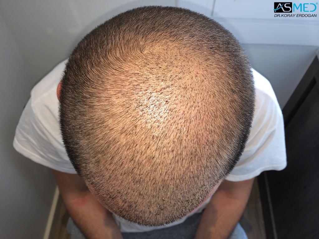 Norwood3 4006-grafts-FUE V2_6d2962d88fd79e60a8f57e9fb160a595_zpsd3bd1d2f