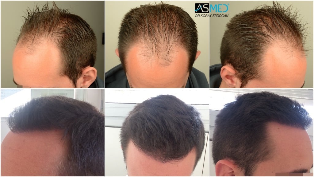4006 Grafts Fue | Norwood 3 | Asmed Hair Transplant Results