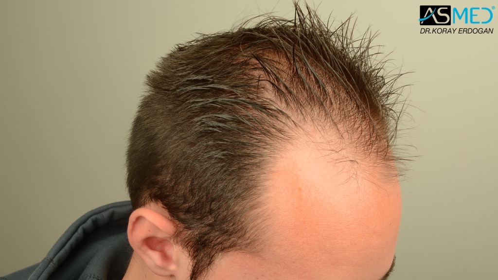 Norwood3 4006-grafts-FUE V2_DSC_4401_zps8b915660