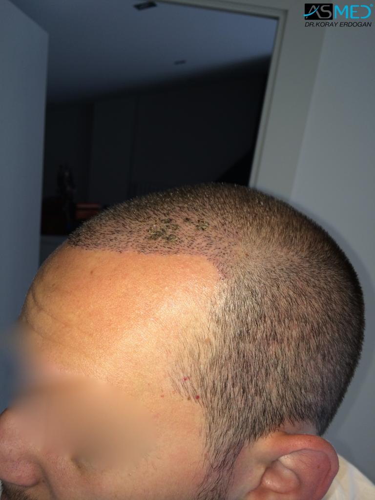 Norwood3 4006-grafts-FUE V2_a613fb3df72c3899d9f4732c466b91bd_zpse006fa93