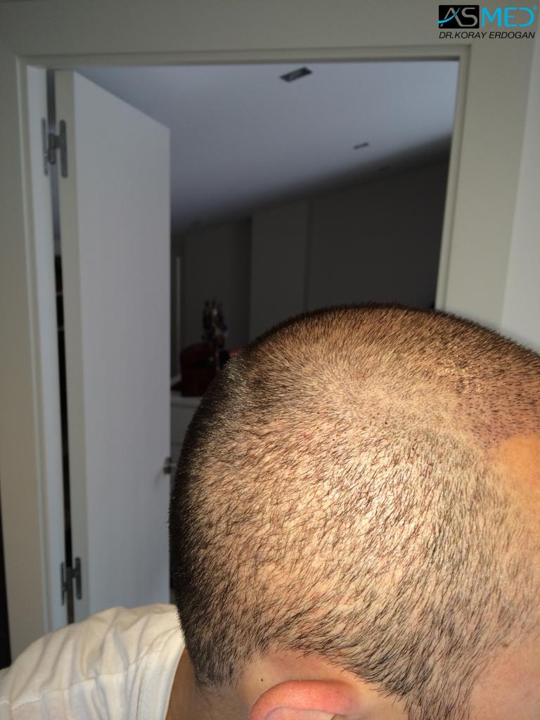 Norwood3 4006-grafts-FUE V2_a95e56ba5d668dffcbbb40cda189122b_zps5cd501b1