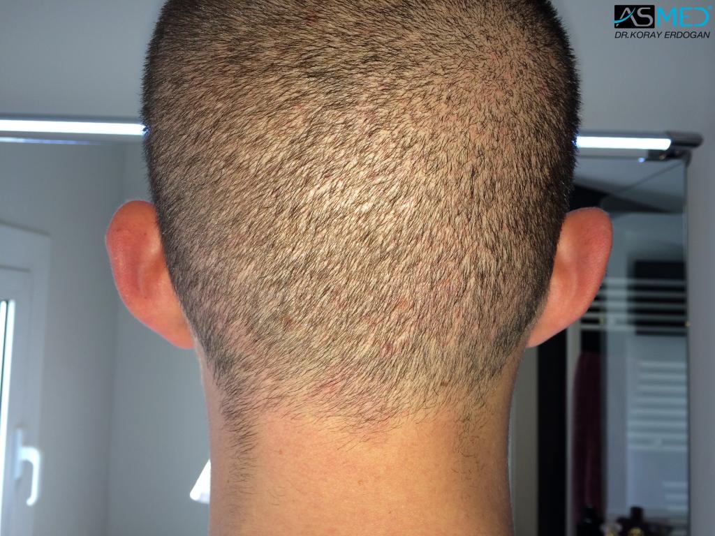 Norwood3 4006-grafts-FUE V2_e7f21fc627f63b3d0ea2f5b248c28110_zps5d76d535