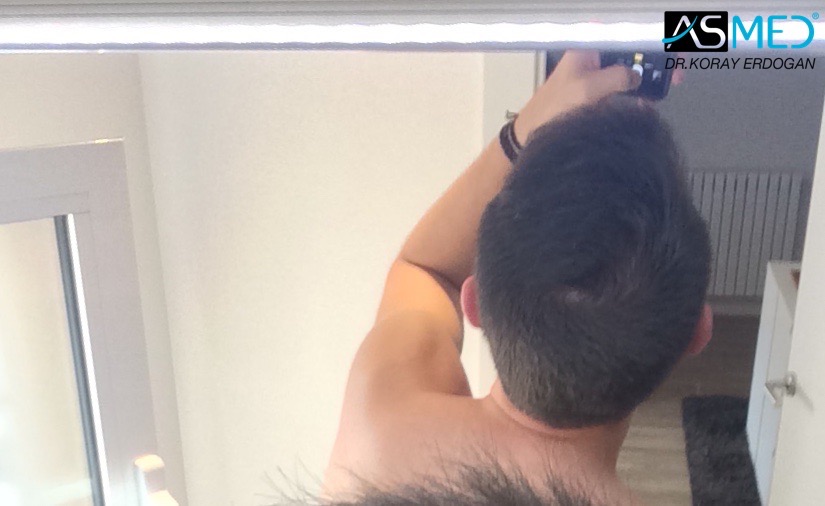 Norwood3 4006-grafts-FUE V2_imagejpg10_zpsee11d2dd