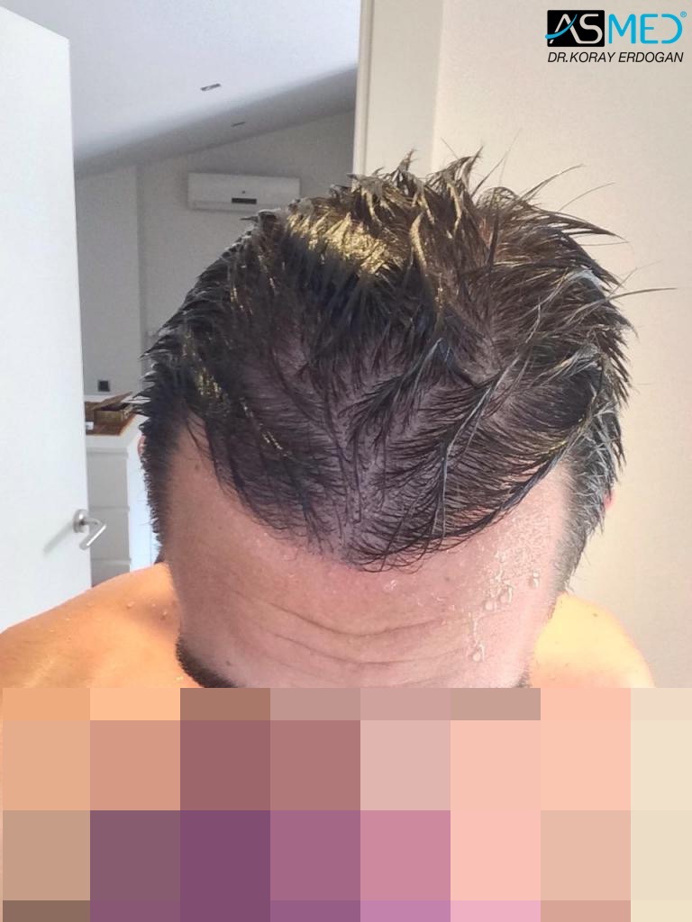 4006 Grafts Fue | Norwood 3 | Asmed Hair Transplant Results 4006 Grafts Fue | Norwood 3 | Asmed Hair Transplant Results