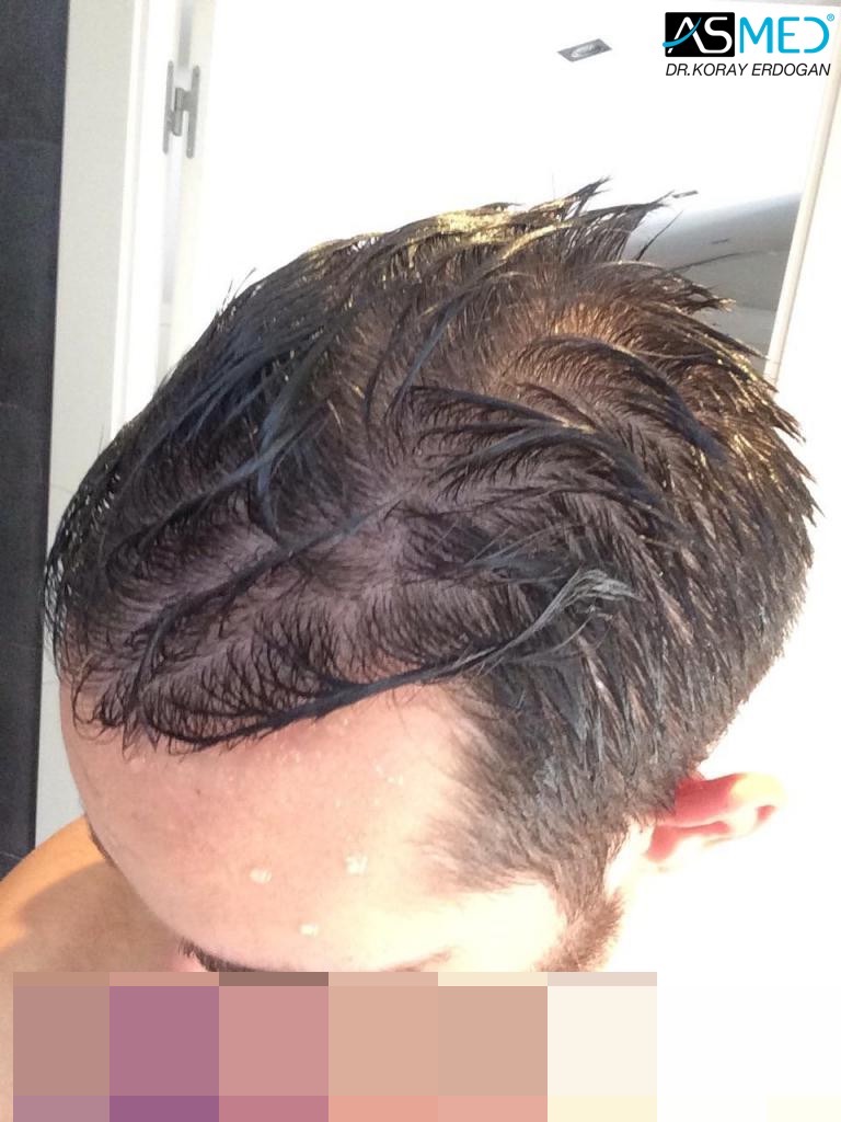 Norwood3 4006-grafts-FUE V2_imagejpg3_zps338d0d50