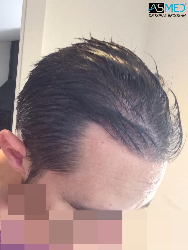 Norwood3 4006-grafts-FUE V2_imagejpg5_zpsb415e3db