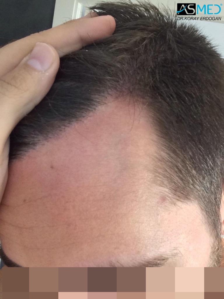 Norwood3 4006-grafts-FUE V2_imagejpg7_zps6ffc1f0b
