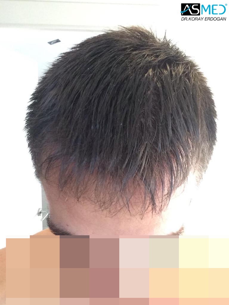 Norwood3 4006-grafts-FUE V2_imagejpg8_zpsb77ae265