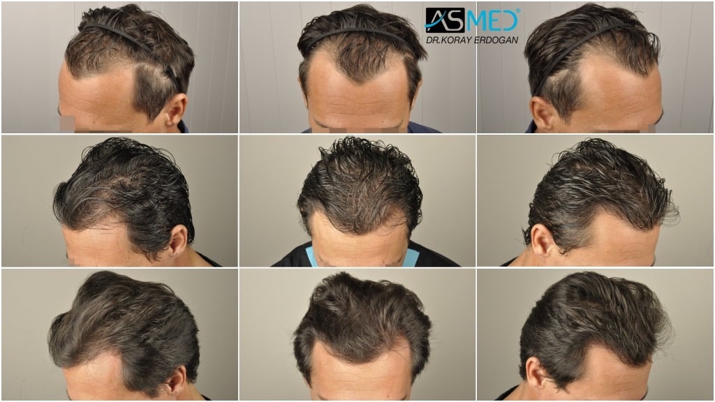 4017-grafts-FUE-2415-FUE-1602-FUE