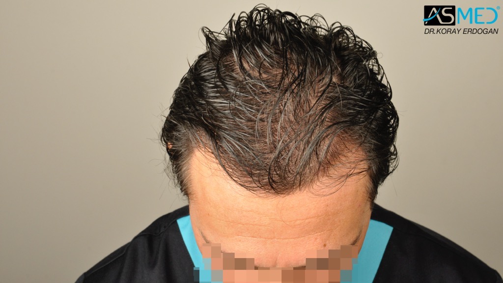 Norwood3 4017-grafts-FUE-2415-FUE-1602-FUE V2__DSC2758_zps358458d7