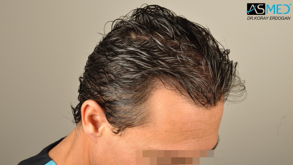 Norwood3 4017-grafts-FUE-2415-FUE-1602-FUE V2__DSC2760_zpsc2ebf2f4