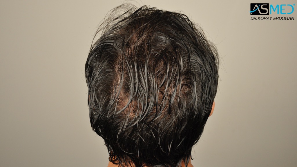 Norwood3 4017-grafts-FUE-2415-FUE-1602-FUE V2__DSC2766_zps7ed4a015