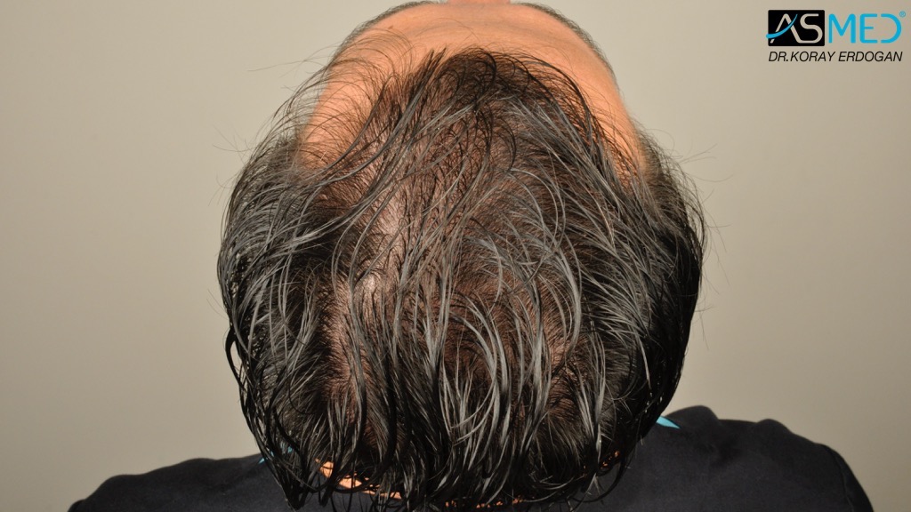 Norwood3 4017-grafts-FUE-2415-FUE-1602-FUE V2__DSC2767_zps084b101d