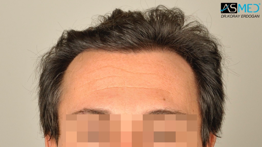 Norwood3 4017-grafts-FUE-2415-FUE-1602-FUE V2__DSC2768_zps40e0a81f