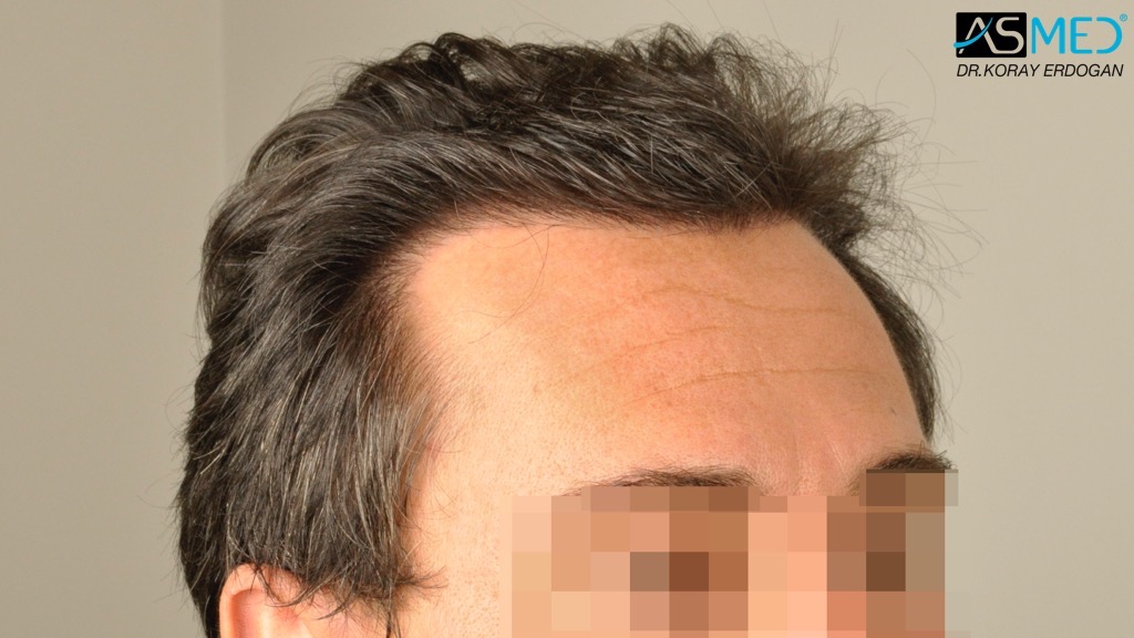 Norwood3 4017-grafts-FUE-2415-FUE-1602-FUE V2__DSC2770_zps69b3d3a6