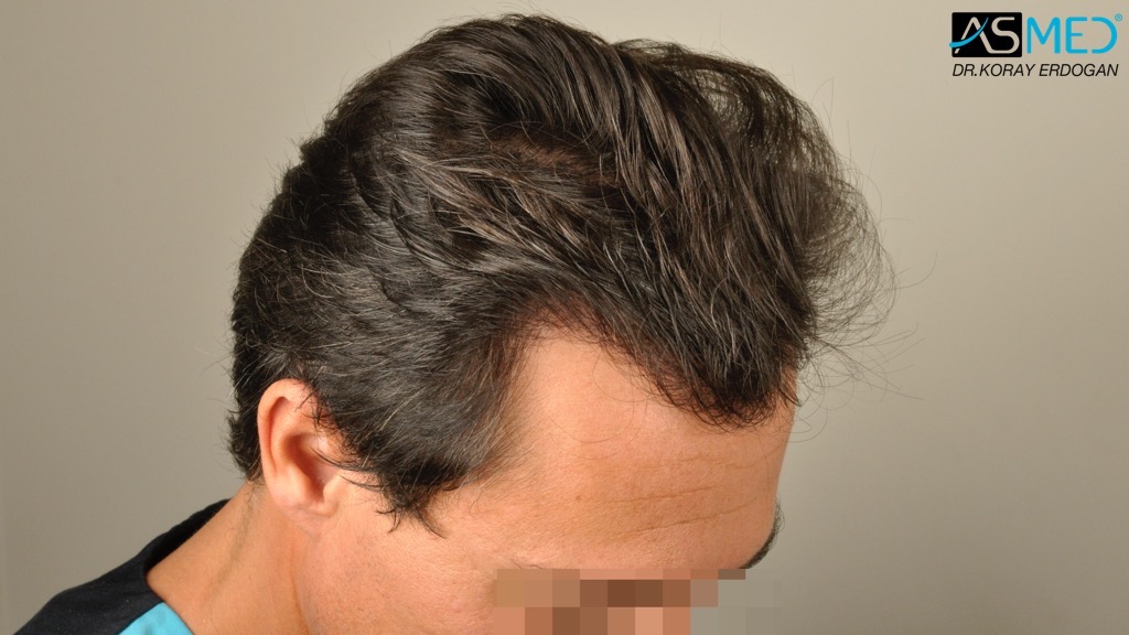Norwood3 4017-grafts-FUE-2415-FUE-1602-FUE V2__DSC2771_zpsafdc80b7