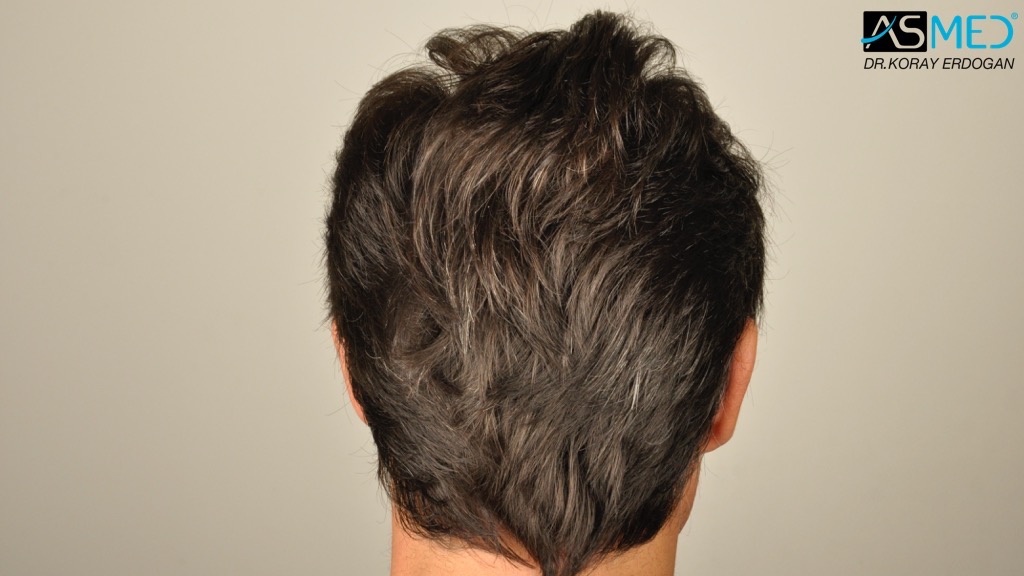 Norwood3 4017-grafts-FUE-2415-FUE-1602-FUE V2__DSC2774_zpsdcc45ed2