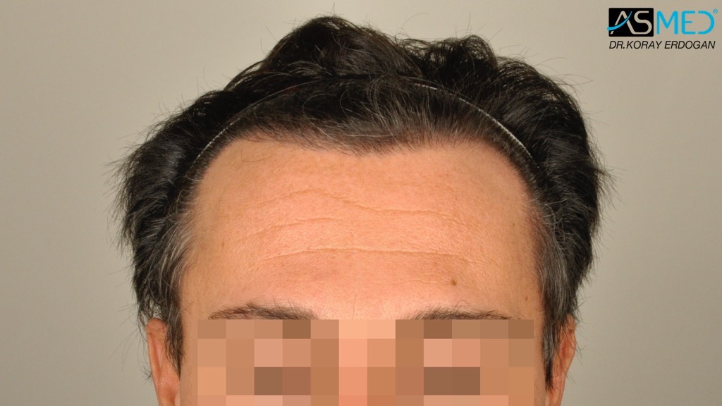 Norwood3 4017-grafts-FUE-2415-FUE-1602-FUE V2__DSC2779_zpsebbe7baa