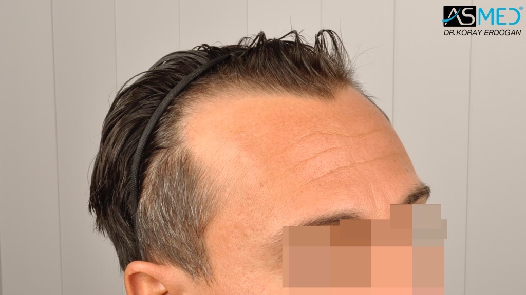Norwood3 4017-grafts-FUE-2415-FUE-1602-FUE V2__DSC2790_zps8b384f08