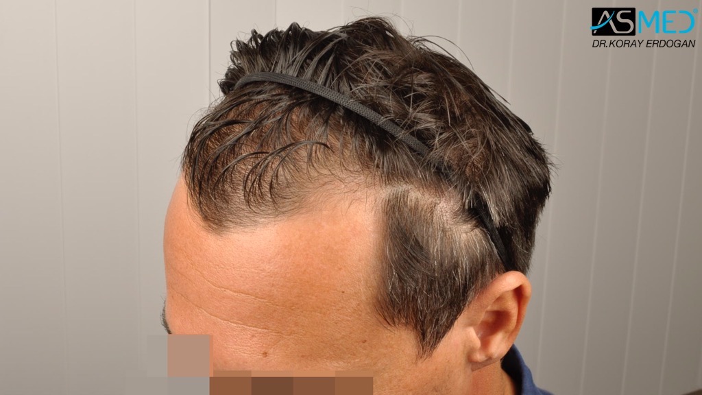Norwood3 4017-grafts-FUE-2415-FUE-1602-FUE V2__DSC2793_zps752c2443