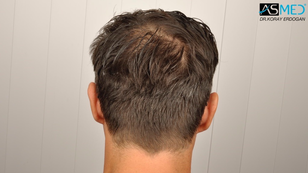 Norwood3 4017-grafts-FUE-2415-FUE-1602-FUE V2__DSC2794_zpse1b18bee