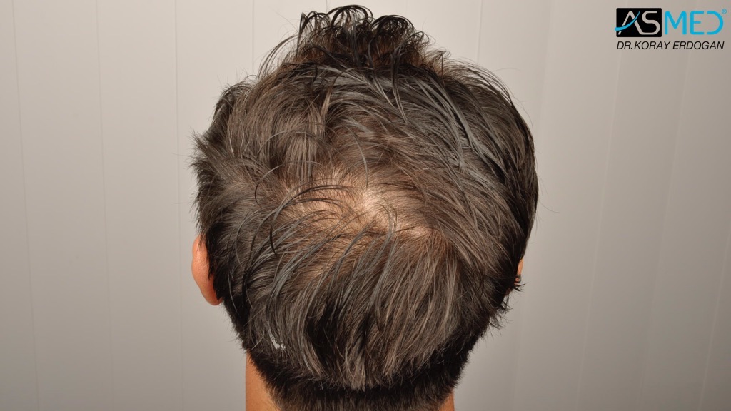 Norwood3 4017-grafts-FUE-2415-FUE-1602-FUE V2__DSC2798_zps1a9f8d4c