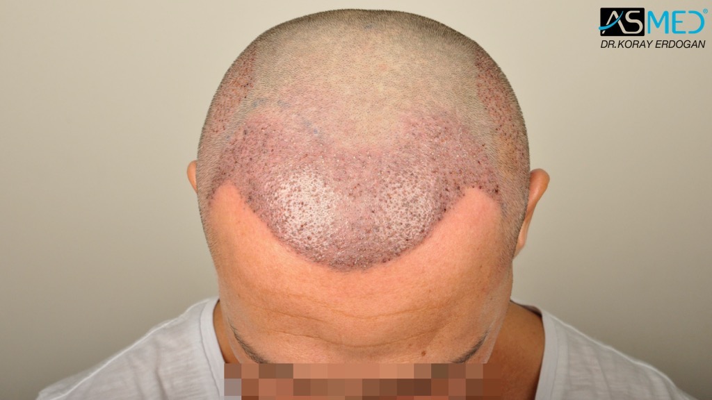 Norwood3 4017-grafts-FUE-2415-FUE-1602-FUE V2__DSC2968_zps0cc1c44f