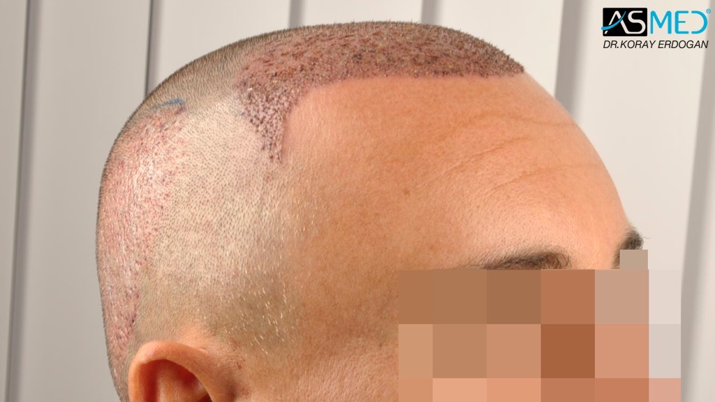 Norwood3 4017-grafts-FUE-2415-FUE-1602-FUE V2__DSC3377_zpse3b2282b