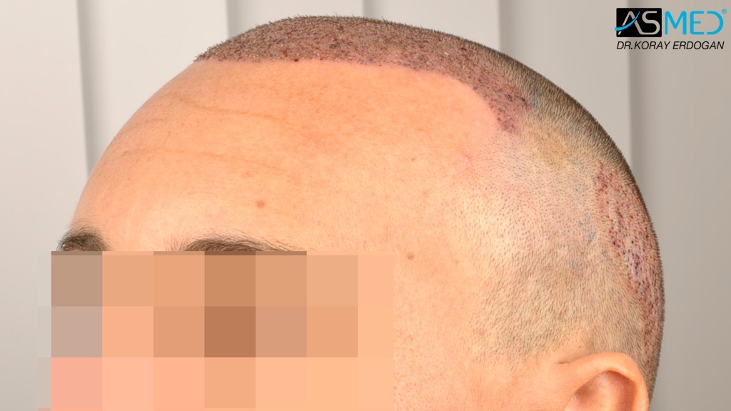 Norwood3 4017-grafts-FUE-2415-FUE-1602-FUE V2__DSC3379_zpsa7ad5d66
