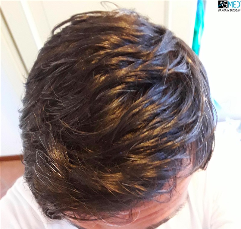 Norwood3 4017-grafts-FUE-2415-FUE-1602-FUE after3years 2_new