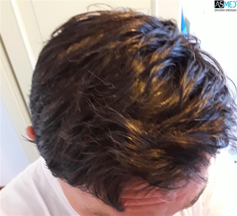 Norwood3 4017-grafts-FUE-2415-FUE-1602-FUE after3years 3_new