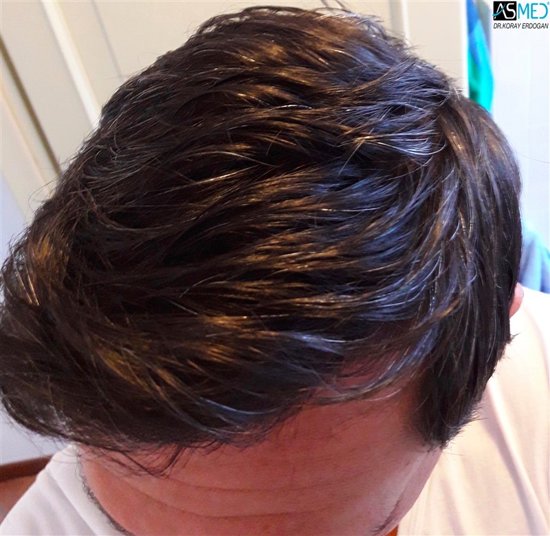 Norwood3 4017-grafts-FUE-2415-FUE-1602-FUE after3years 4_new