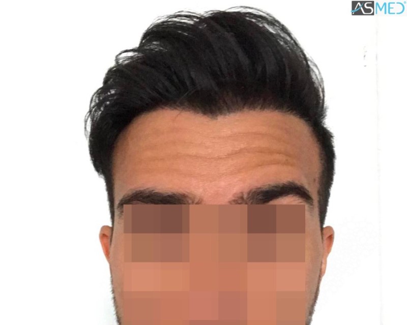 Norwood3 4143-grafts-FUE 16month 10_V2