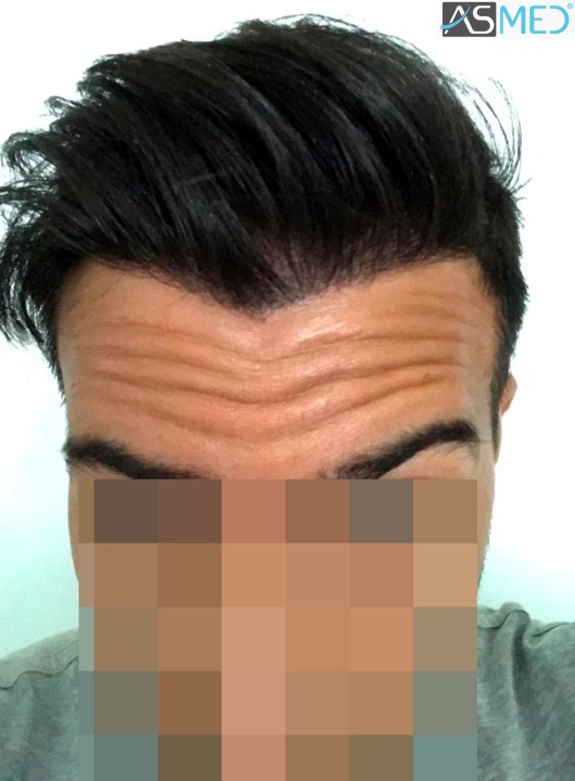 Norwood3 4143-grafts-FUE 16month 11_V2
