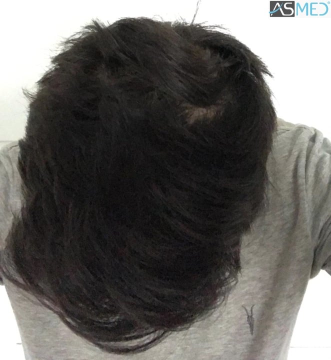 Norwood3 4143-grafts-FUE 16month 12_V2