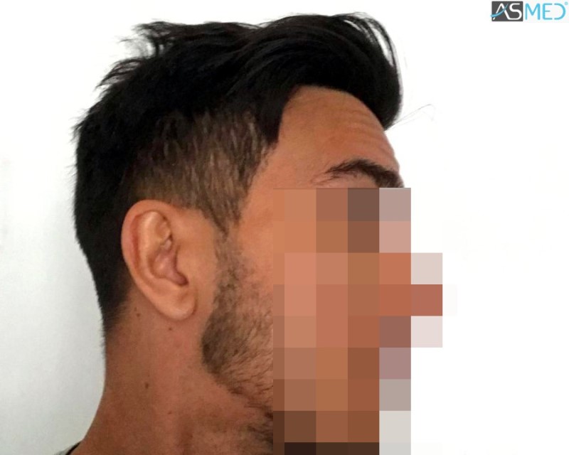 Norwood3 4143-grafts-FUE 16month 13_V2