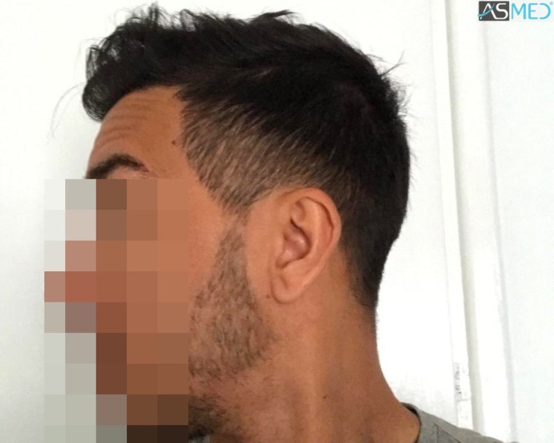 Norwood3 4143-grafts-FUE 16month 14_V2